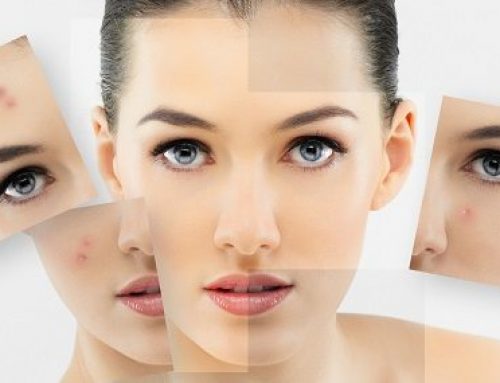 What Are Some Acne Solutions that REALLY Work?