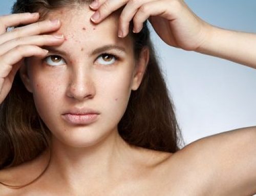 What Can Be Done About Acne at Home?