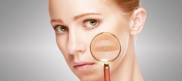 Add Microneedling in Your Battle with Melasma