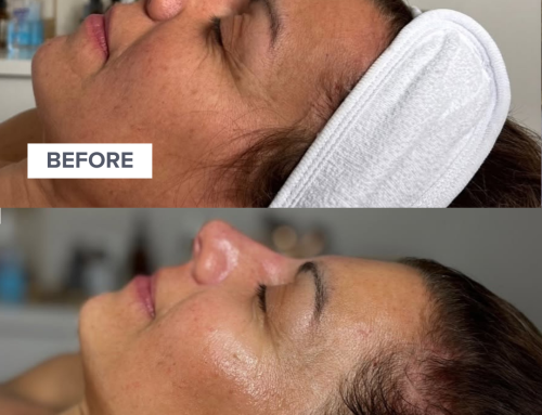 The Secret to Restoring Your Complexion