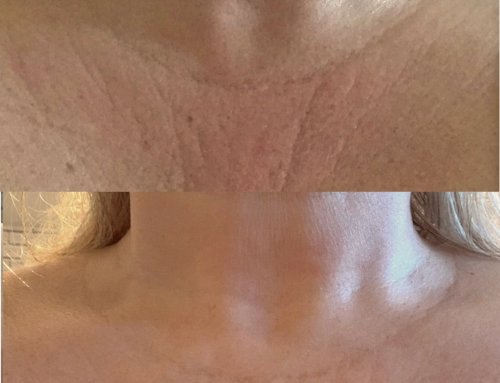 The Skin-Rejuvenating Benefits of Laser Genesis