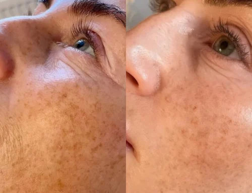 Add Microneedling in Your Battle with Melasma